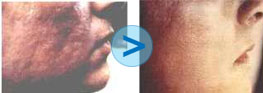 Correction de cicatrices d'acn� ou de varicelle