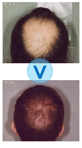 Avant et apr�s une microgreffe de cheveux