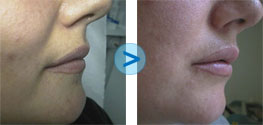 R�sultats du Bio-Alcamid sur les l�vres
