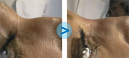 R�sultats du Bio-Alcamid sur le nez