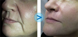 R�sultats du Bio-Alcamid sur les rides
