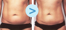 Photos thermage : Traitement sur l'abdomen