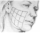 Schéma d'un remaillage du visage